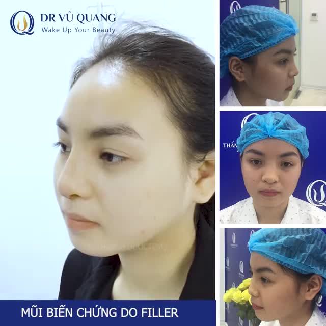 Dr Vũ Quang sửa mũi có đẹp không ?