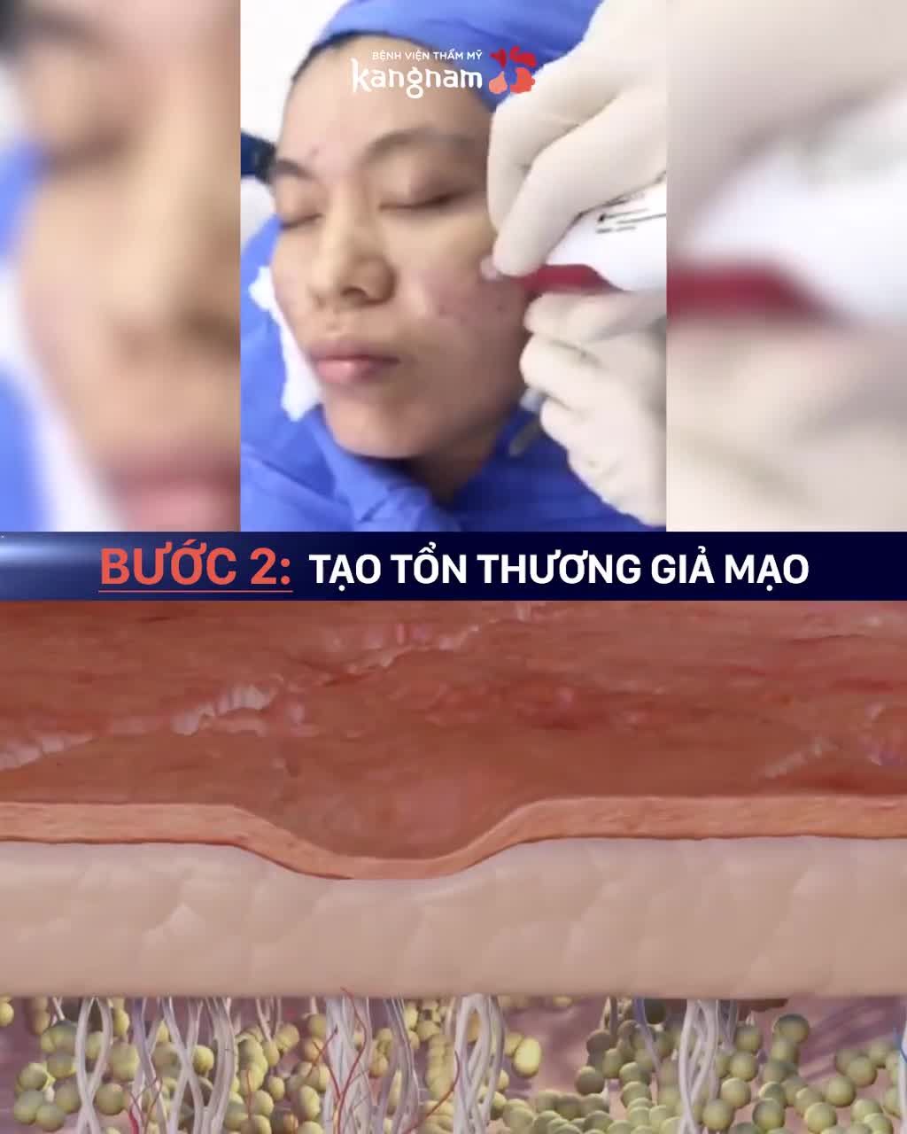 1 liệu trình lấp đầy tối đa SẸO LÕM, RỖ