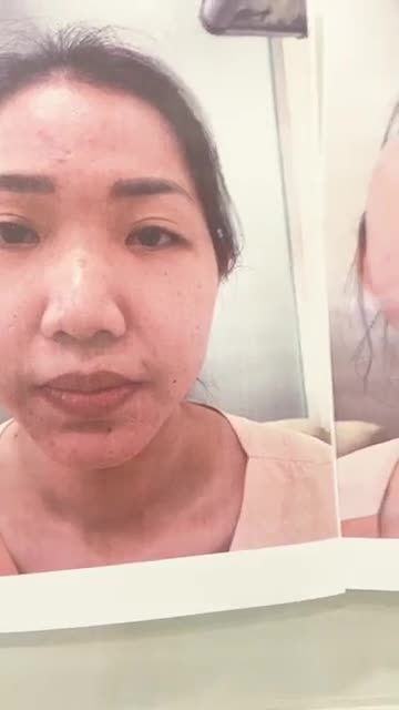 Khách hàng sóng mũi thấp, đầu mũi cụp, đầu mũi to, cánh mũi bè.
