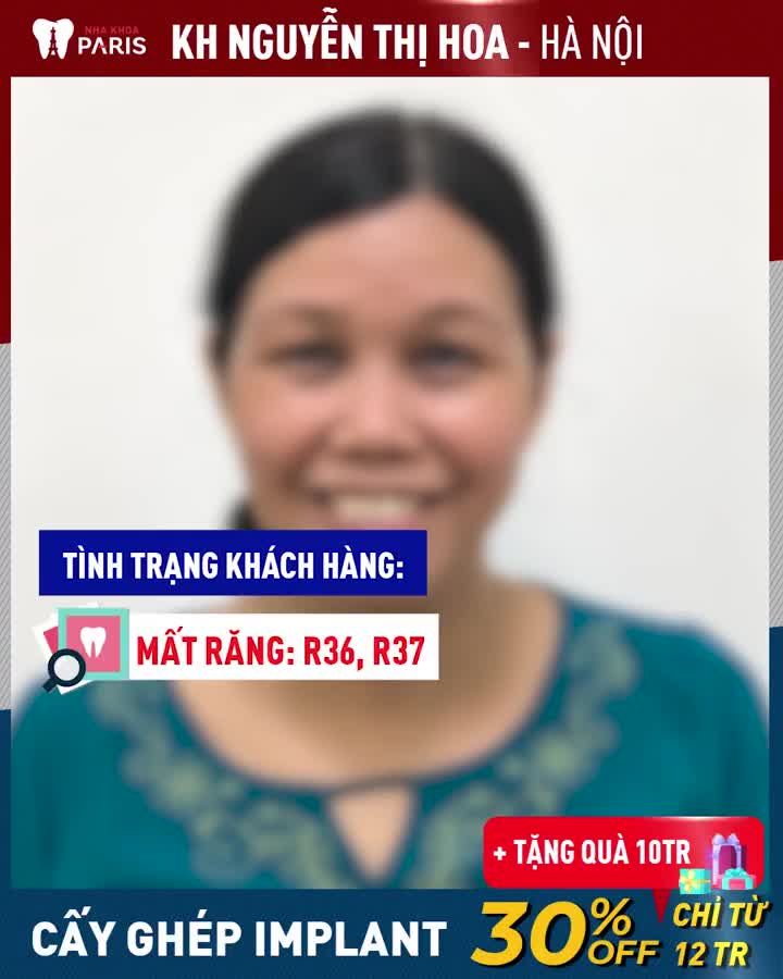 Trồng Răng Implant 5 ngày ăn nhai bền tốt