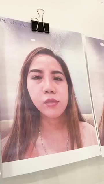 MŨI CẤU TRÚC SURGIFORM CHO KHÁCH HÀNG HÀ NỘI TỪNG SỬA MŨI 4 LẦN