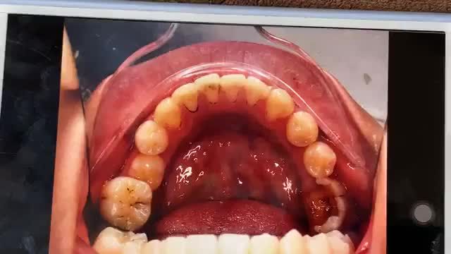 GẮN MẮC CÀI CHO KHÁCH VỚI HÀM RĂNG KHẤP KHỂNH - CẮN ĐỐI ĐẦU