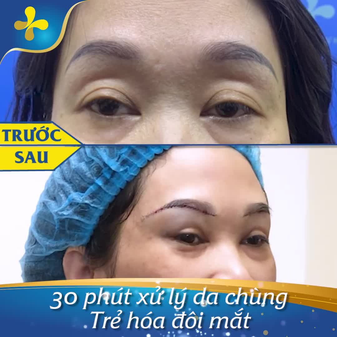 Hôm nay bác sĩ xin gửi đến cả nhà ca treo cung mày - Xử lý da chùng, mí sụp và trẻ hóa đôi mắt cho chị khách hàng U46.