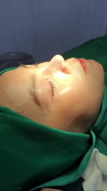 Nâng mũi bán cấu trúc 2 lớp Dáng Sline kết hợp Lline Đầu mũi tròn, dáng túi mật thần thánh