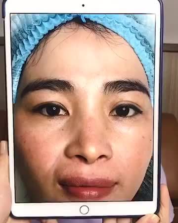 Cắt mí sau 3 tháng 7 ngày sẽ như thế nào? Cùng Dr.Hải Lê chiêm ngưỡng kết quả nhé!