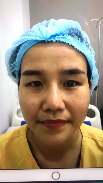 Kết quả cắt mí Mani Open Deep 5D sau 7 ngày đã bình phục chưa? quý khách hàng cùng theo dõi video và để lại câu hỏi để được giải đáp hoàn toàn miễn phí