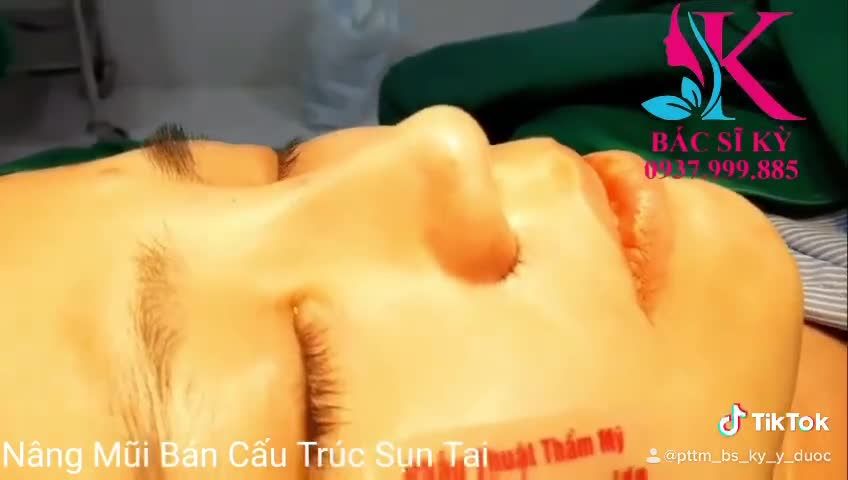 SIÊU HOT NÂNG MŨI BÁN CẤU TRÚC CUỘN CÁNH MŨI PLASMA