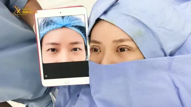 "KHỐN KHỔ" NHẤT KHÔNG PHẢI LÀ MẮT 1 MÍ, MÀ LÀ CÓ 2 MÍ NHƯNG MÍ MẮT BỊ SỤP