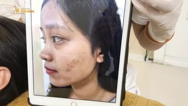 CHỈ TỪ VẾT MỤN MÀ THÀNH ĐỐM THÂM TO BÊN MÁ 4 BUỔI TRỊ LIỆU SẮC TỐ LASER LUCID Q-PTP TẠI TMV XUÂN HƯƠNG VÀ CÁI KẾT "ẤM LÒNG"