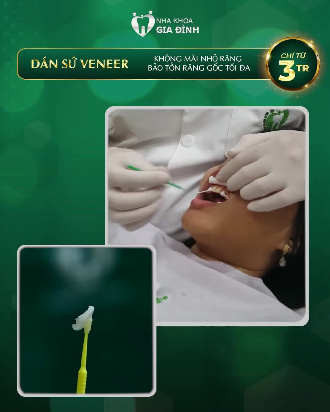 DÁN SỨ VENEER – NÂNG CẤP NỤ CƯỜI KHIẾM KHUYẾT