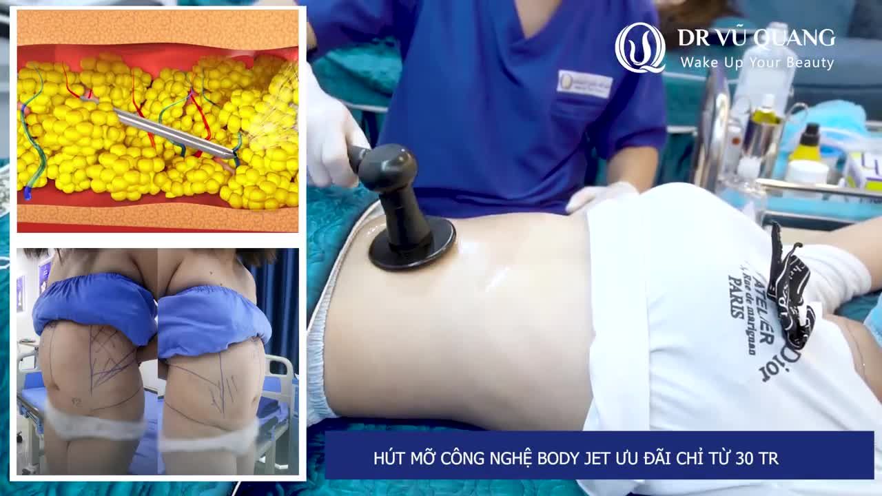 HÚT MỠ BODY JET