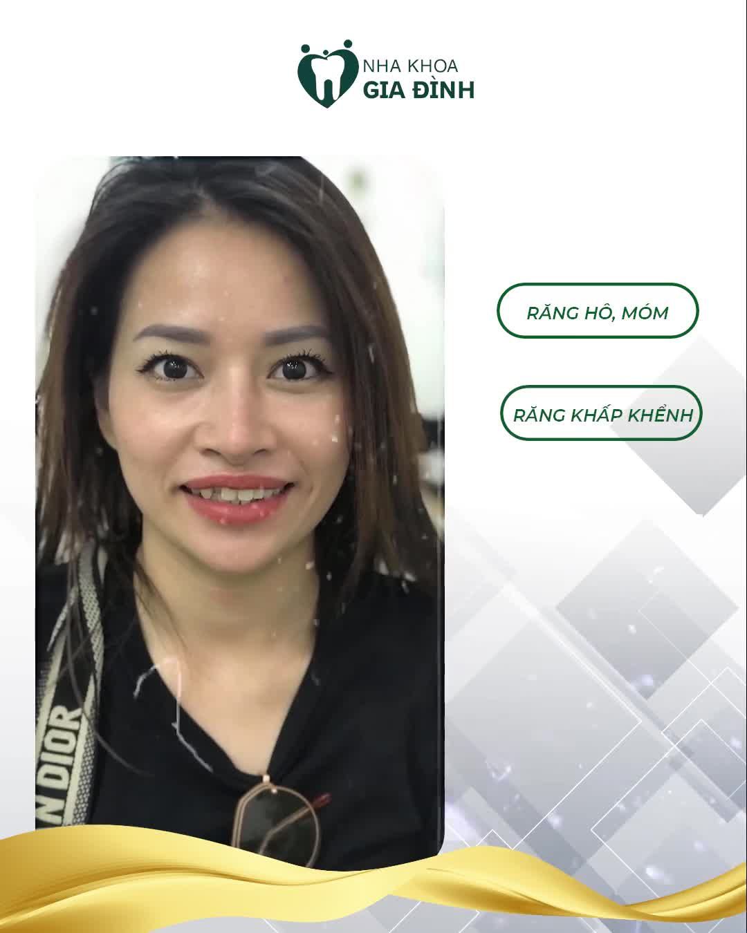 NHỮNG TRƯỜNG HỢP NÀO NÊN BỌC RĂNG SỨ