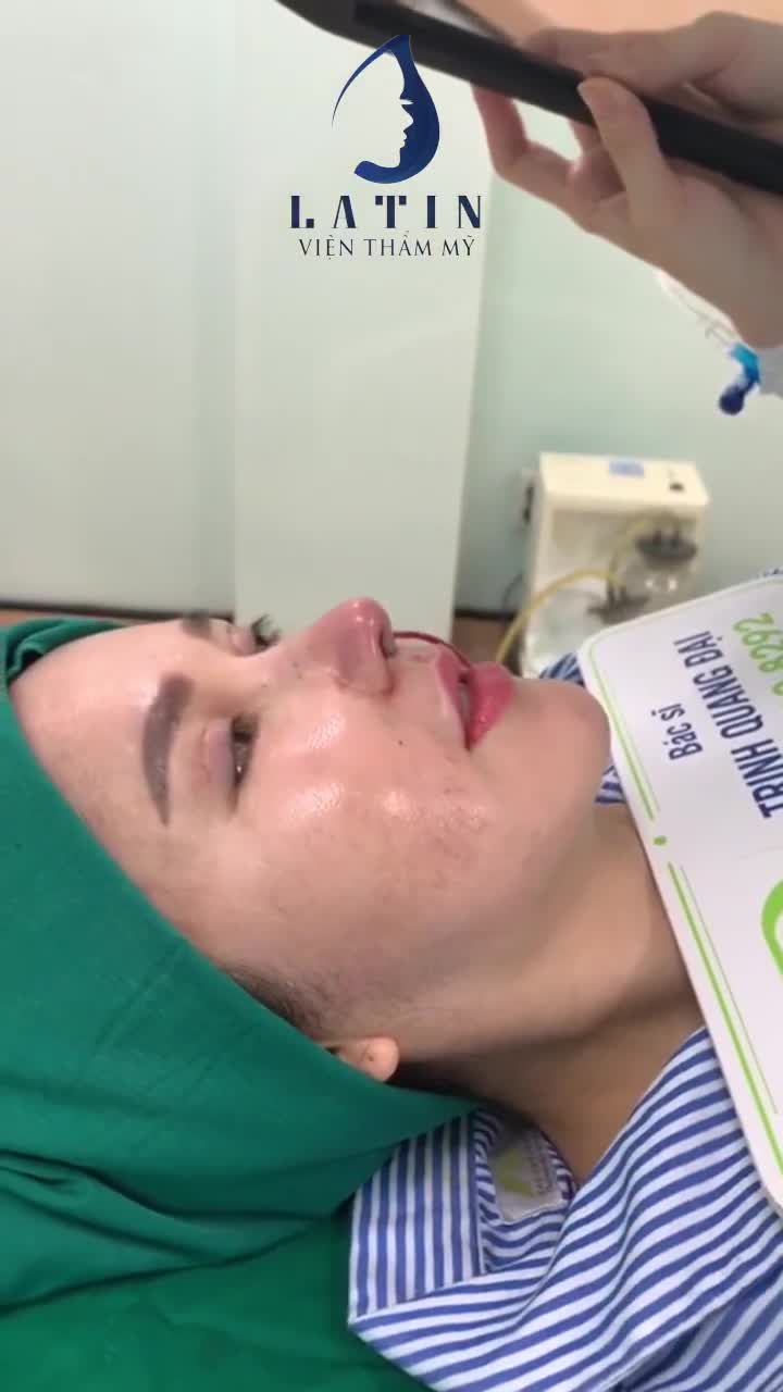 CA MŨI SỬA LẠI CẤU TRÚC LẦN 3 SIÊU V.I.P
