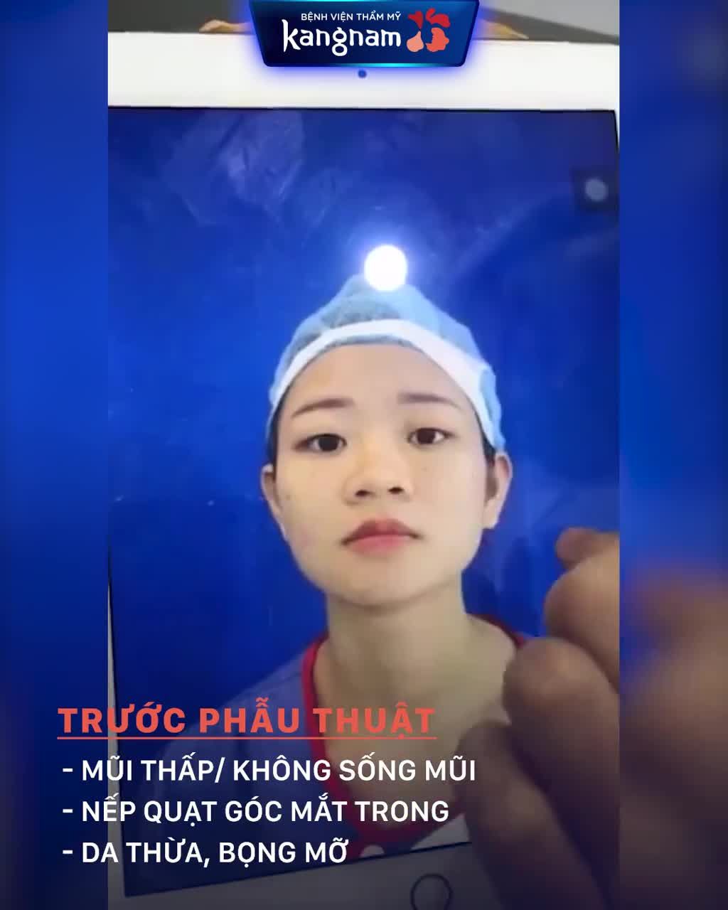 Cắt mí + Nâng mũi - Combo "Dậy thì thành công" của mọi cô gái!