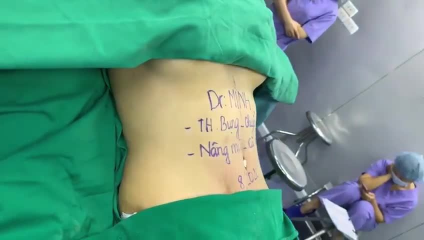 Combo Tạo hình thành bụng chuyển rốn - nâng mũi - cấy mỡ