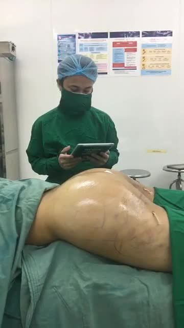 Cùng đón xem kết quả dịch vụ Cấy Mỡ Mông để thấy sự thay đổi của vị khách hàng này thế nào nhé!