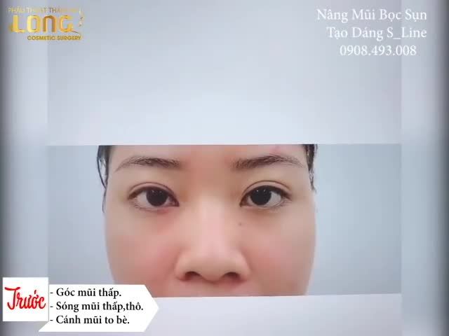 Nâng mũi bọc sụn tai tạo dáng Sline tự nhiên như mũi thật