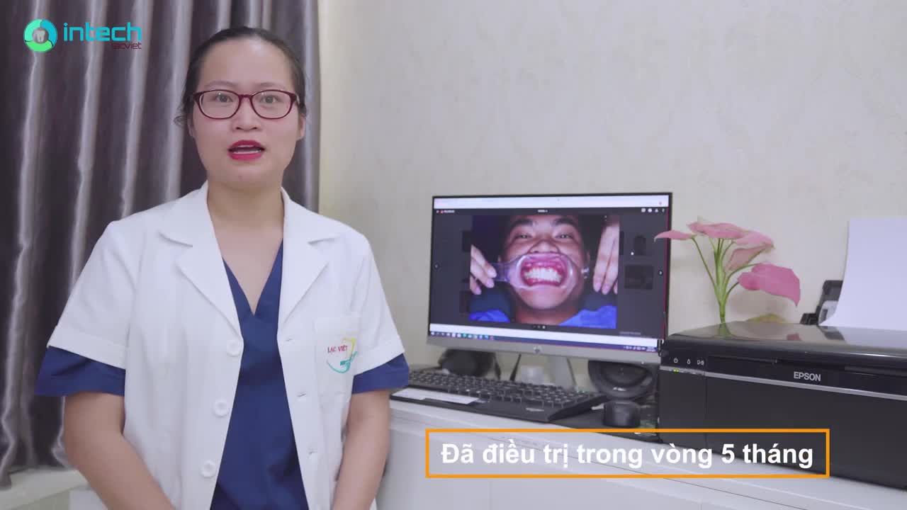 PHÂN TÍCH LÂM SÀNG: THAY ĐỔI NGOẠN MỤC CHỈ VỚI 6 THÁNG NIỀNG RĂNG KHẤP KHỂNH
