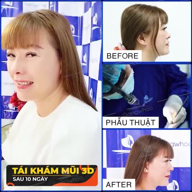TÁI KHÁM DÁNG MŨI NANOFORM 3D SAU 10 NGÀY
