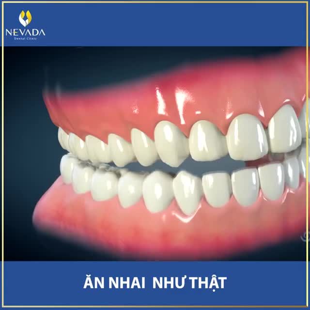 VÌ SAO  CẤY GHÉP IMPLANT ĐƯỢC ƯA CHUỘNG ĐẾN VẬY?