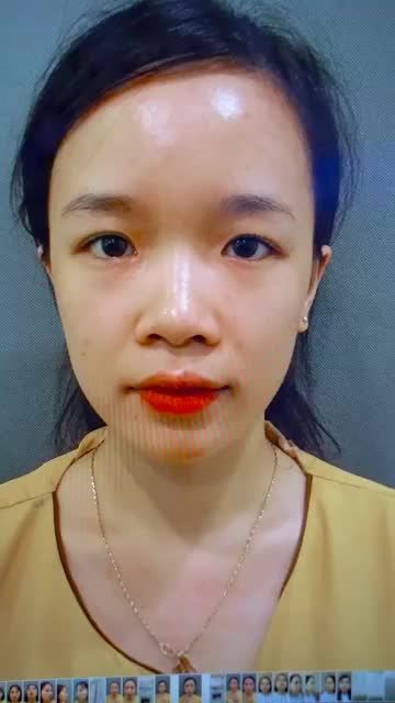 Bạn mắt một mí, sụp mí, mí lót u buồn đừng dùng kích mí tạm thời rất có hại cho mắt bạn nhé. Hãy can đảm Cắt mí để có nếp mí đẹp trọn đời dài lâu!