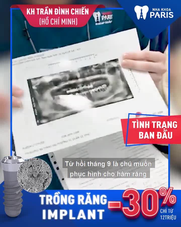 THỜI ĐIỂM VÀNG TRỒNG RĂNG IMPLANT LÀ KHI NÀO