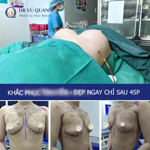TUẦN LỄ VÀNG CHO NÀNG NÂNG NGỰC ChỈ TỪ 43 tr