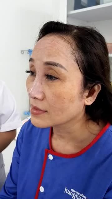"Khôi phục" dáng mũi hoàn hảo với công nghệ nâng mũi Cấu trúc 4D