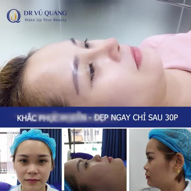 Cận cảnh dáng mũi Softline sau 7 ngày.