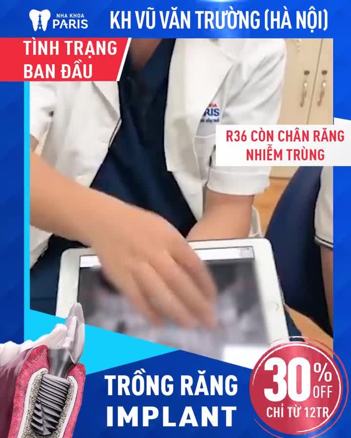 Mất Răng - Ăn Nhai Kém » TRỒNG RĂNG IMPLANT