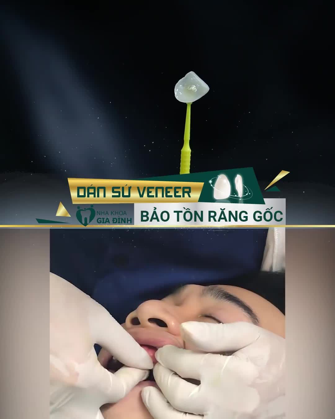 5 ƯU ĐIỂM VƯỢT TRỘI CỦA DÁN SỨ VENEER