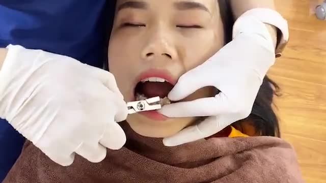 BUNG LỤA CHO KHÁCH HÀNG HÀM RĂNG KHẤP KHỂNH