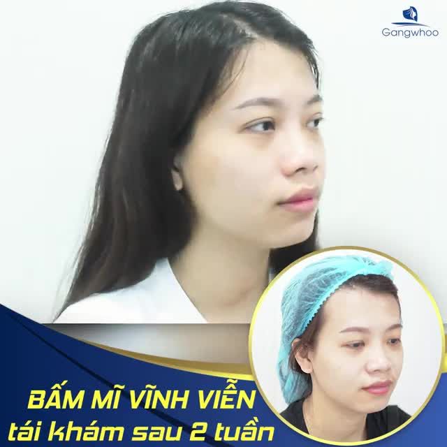 NÂNG CẤP ĐÔI MẮT ĐẸP HOÀN HẢO CHỈ VỚI 45 PHÚT KHÔNG CẦN PHẪU THUẬT