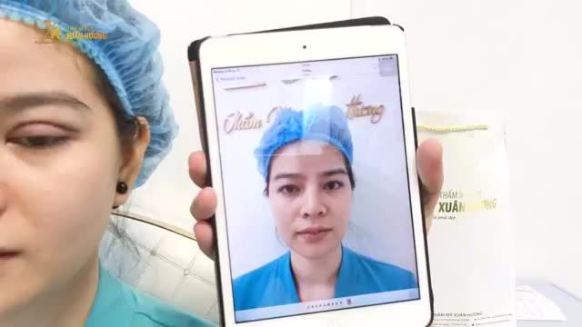 NẾP MÍ TRÊN NHIỀU MỠ THỪA KHIẾN MÍ SỤP, KHUÔN MẮT BUỒN