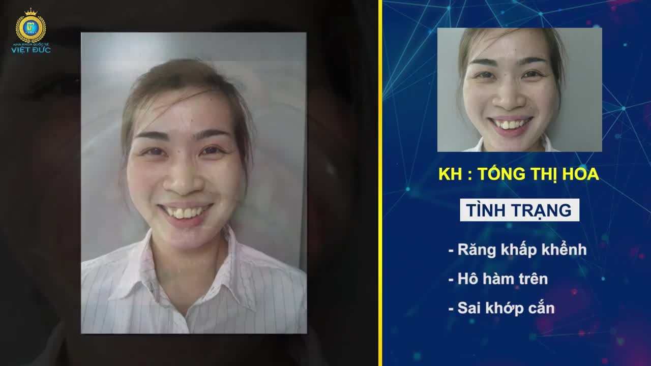 RĂNG 9630 KHẤP KHỂNH ĐẾN ĐÂU NIỀNG RĂNG BRACES 6S ĐỀU KHẮC PHỤC ĐƯỢC HẾT