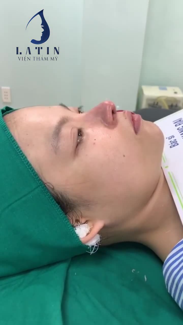 SIÊU PHẨM MŨI CẤU TRÚC LÓT MEGADERM SAU 2H