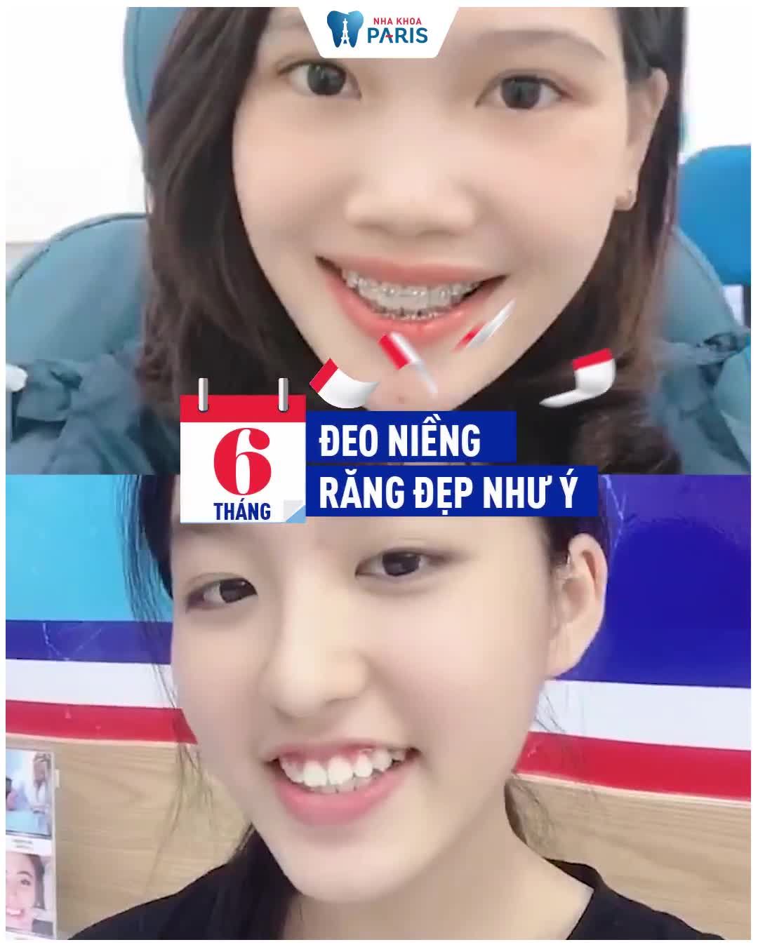 6 THÁNG NIỀNG >>> RĂNG ĐỀU ĐẸP