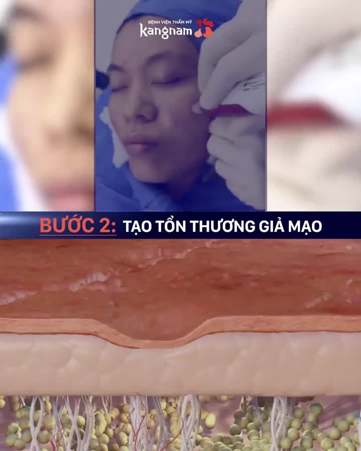 1 liệu trình lấp đầy tối đa SẸO LÕM, RỖ