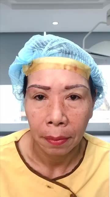 Nâng chân mày giải pháp khắc phục hoàn toàn tình trạng da chùng sụp mí U40+