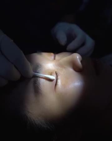 Cùng xem quá trình cắt chỉ sau khi cắt mí được 7 ngày tại Dr.Hải Lê!