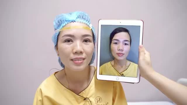 Mắt sụp mí, đuôi mắt cụp nhỏ u buồn già nua xử lý như thế nào?