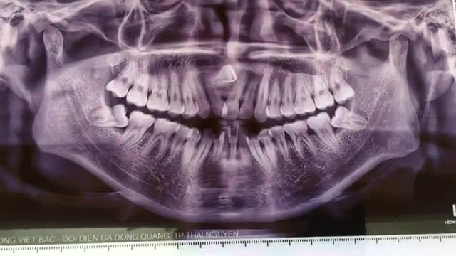 Nhổ răng khôn số 38 mọc lệch 45 độ đâm vào răng 7 cho bạn Hiền đang chỉnh nha tại Nha Khoa Thuỳ Anh