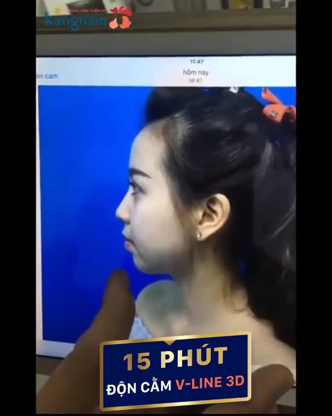 Dáng cằm V-line quá hoàn hảo chỉ với 15 phút độn cằm Hàn Quốc