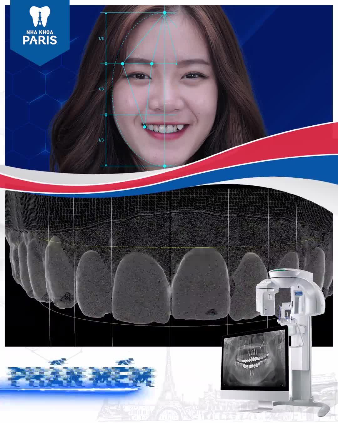 2 NGÀY BỌC SỨ >> RĂNG SÁNG BÓNG, ĐỀU ĐẸP