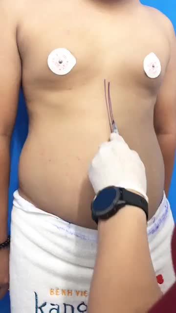 Cùng bác sĩ đo vẽ và thiết kế Vòng 2 cho khách hàng nam làm dịch vụ Giảm mỡ bụng eo tại Bệnh viện thẩm mỹ Kangnam.