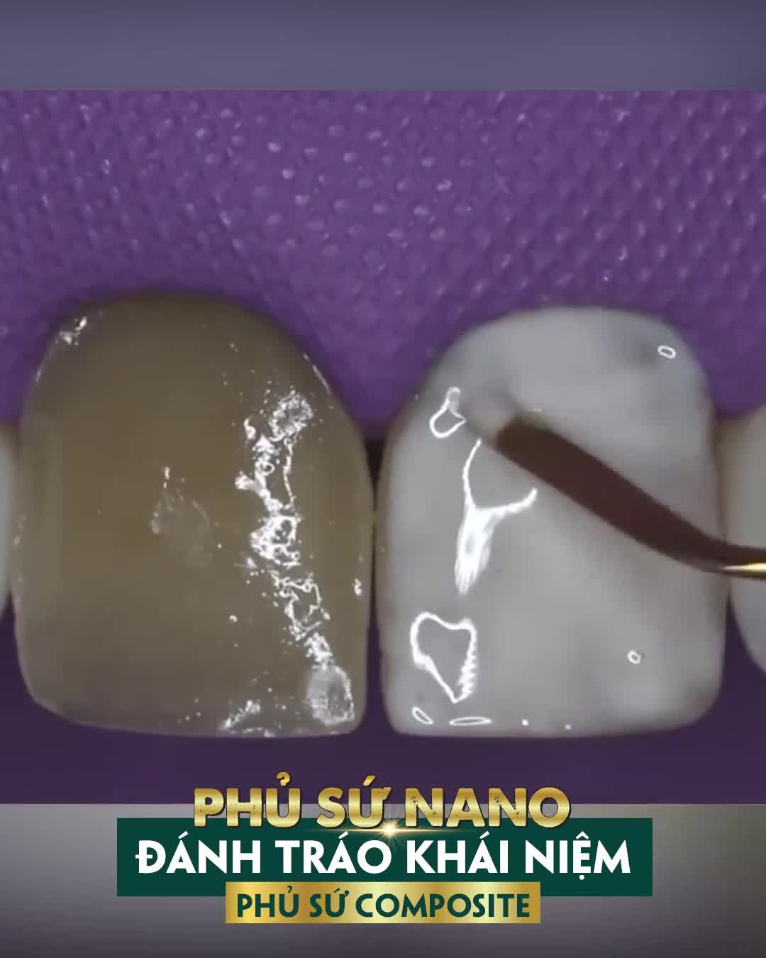 PHỦ SỨ NANO CHÍNH LÀ PHÁ RĂNG ĐỂ LÀM ĐẸP