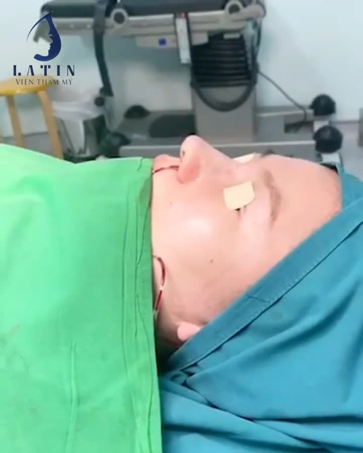CẬN CẢNH |MŨI SỬA LẠI SIÊU CẤU TRÚC SỤN SƯỜN