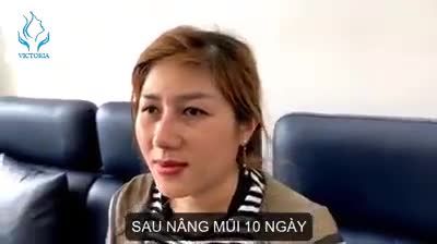 NGẮM KẾT QUẢ NÂNG MŨI CẤU TRÚC CAO TÂY SAU 10 NGÀY