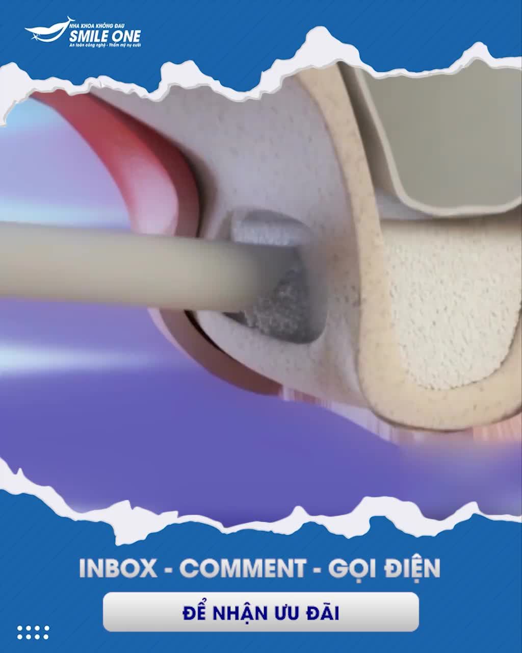 PHỤC HỒI CHỨC NĂNG ĂN NHAI CHO BỆNH NHÂN BẰNG IMPLANT
