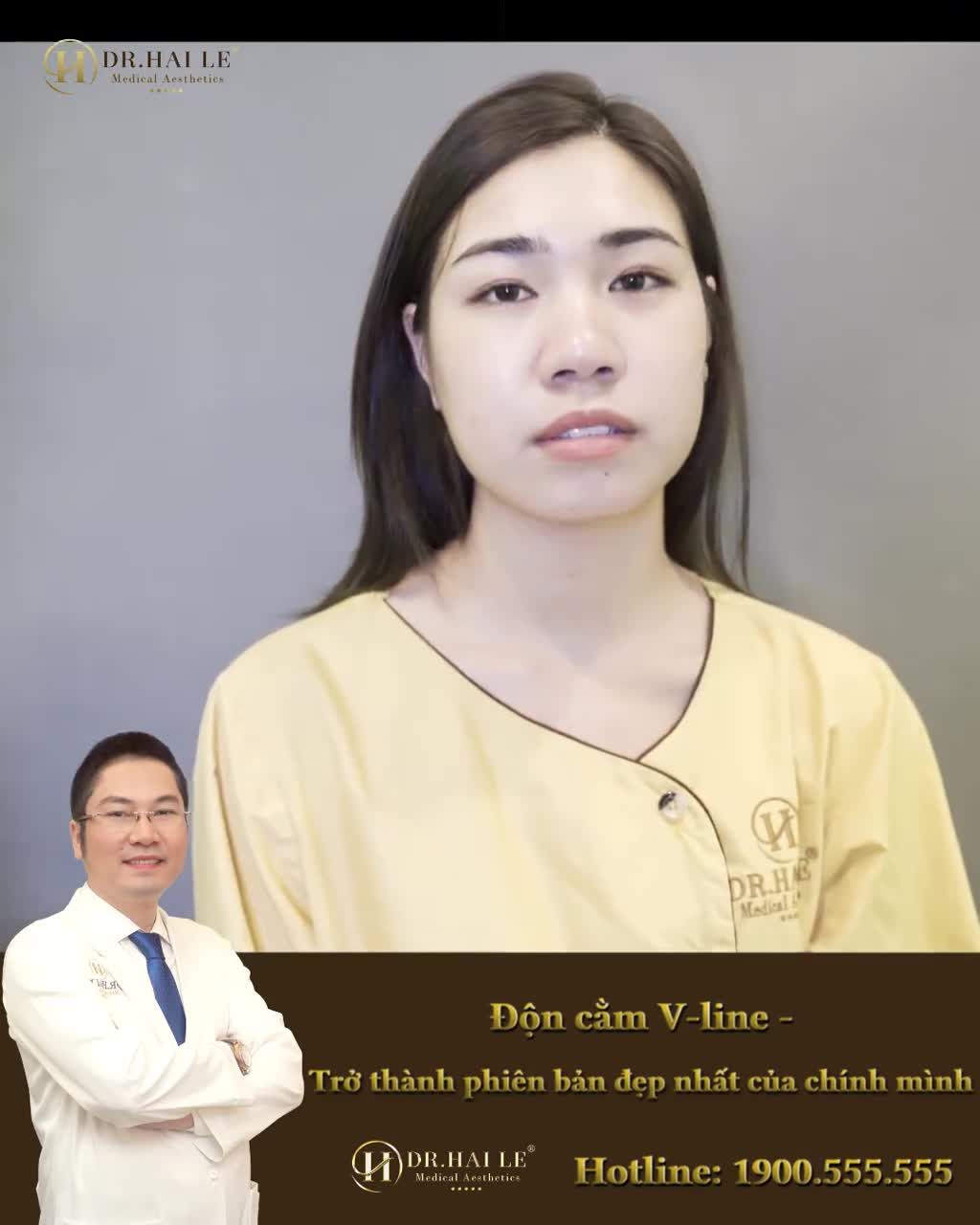 ĐỘN CẰM V-LINE - TRỞ THÀNH PHIÊN BẢN ĐẸP NHẤT CỦA CHÍNH MÌNH
